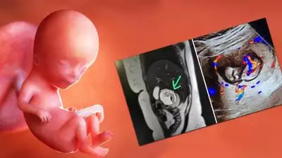 'ഗർഭപാത്രത്തിലല്ല മുപ്പതുകാരിയുടെ കരളിനുള്ളിൽ കണ്ടെത്തിയത് മൂന്നുമാസം പ്രായമുള്ള ഭ്രൂണം'; അപൂർവങ്ങളിൽ അപൂർവമായ അവസ്ഥ ഇന്ത്യയിൽ ആദ്യം