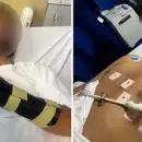 ഇന്ത്യൻ വംശജന് നേരെ ഓസ്‌ട്രേലിയയിൽ ആക്രമണം; കൈ ഒടിഞ്ഞു, ഗുരുതര പരിക്ക്