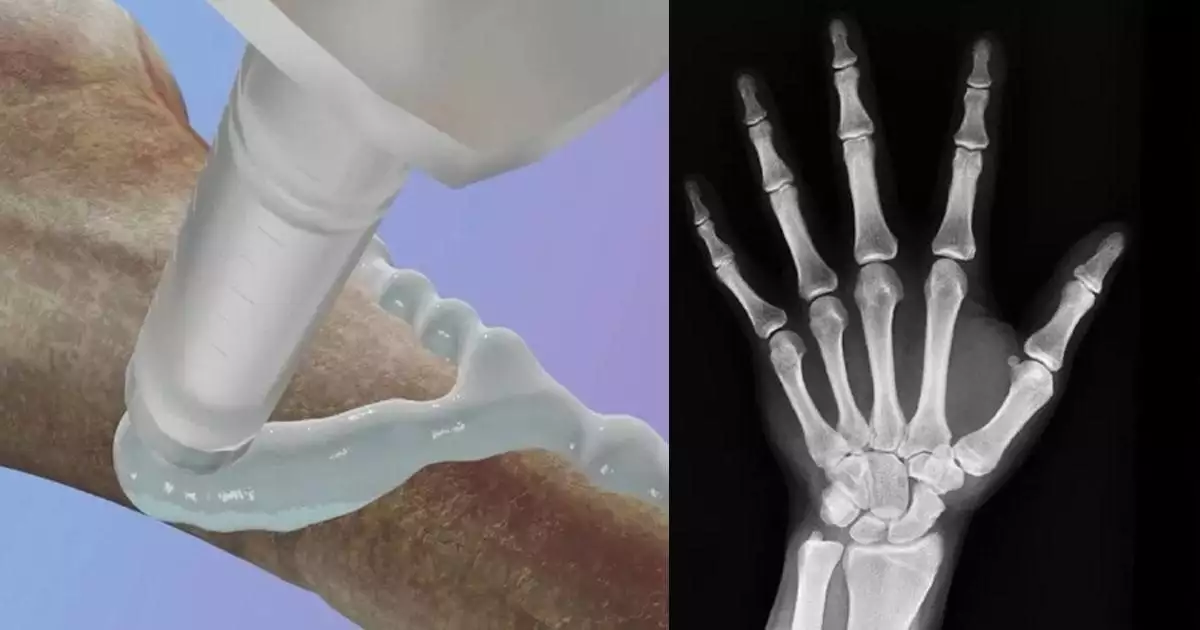 എല്ല് പൊട്ടിയാൽ ഇനി ഒട്ടിച്ച് നേരെയാക്കാം; എന്താണ് ബോൺ ഗ്ലൂ?