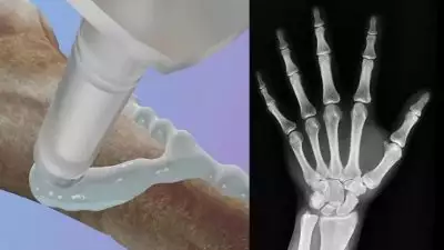 എല്ല് പൊട്ടിയാൽ ഇനി ഒട്ടിച്ച് നേരെയാക്കാം; എന്താണ് ബോൺ ഗ്ലൂ?