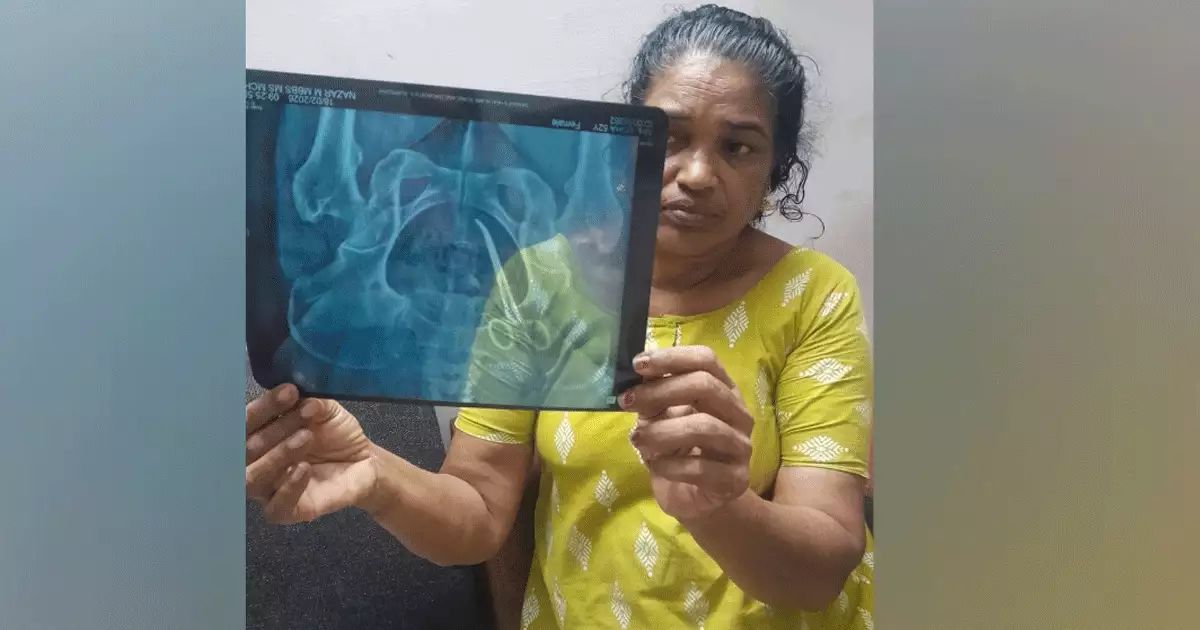 വീട്ടമ്മയുടെ വയറ്റിൽ 5 വർഷമായി കത്രിക; ആലപ്പുഴ മെഡിക്കൽ കോളേജിലെ ശസ്ത്രക്രിയക്കിടെ മറന്നുവെച്ചതെന്ന് പരാതി