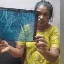 വീട്ടമ്മയുടെ വയറ്റിൽ 5 വർഷമായി കത്രിക; ആലപ്പുഴ മെഡിക്കൽ കോളേജിലെ ശസ്ത്രക്രിയക്കിടെ മറന്നുവെച്ചതെന്ന് പരാതി