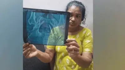 വീട്ടമ്മയുടെ വയറ്റിൽ 5 വർഷമായി കത്രിക; ആലപ്പുഴ മെഡിക്കൽ കോളേജിലെ ശസ്ത്രക്രിയക്കിടെ മറന്നുവെച്ചതെന്ന് പരാതി